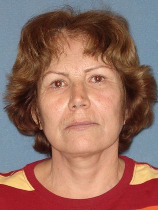 Laser Skin Resurfacing Case 18 - Before