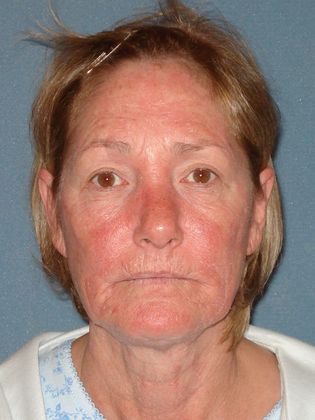 Laser Skin Resurfacing Case 19 - Before