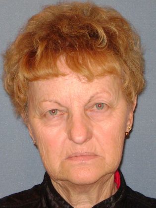 Laser Skin Resurfacing Case 20 - Before