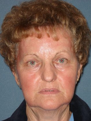 Laser Skin Resurfacing Case 20 - After