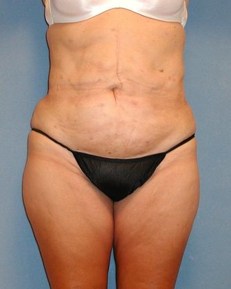 Liposuction: Case 9 - After - Front