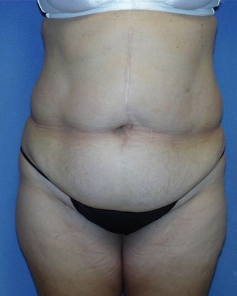 Liposuction: Case 9 - Before - Front
