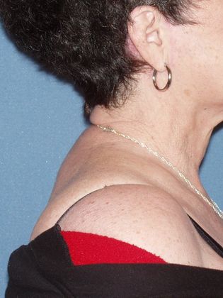 Liposuction: Case 13 - After - Side