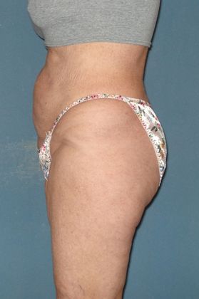 Liposuction: Case 15 - After - Side