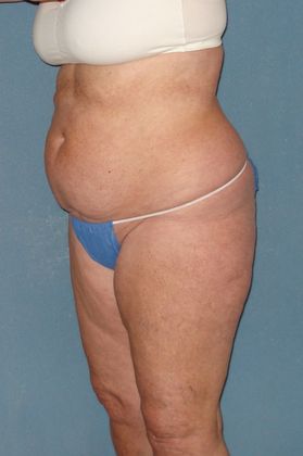 Liposuction: Case 15 - Before - Side