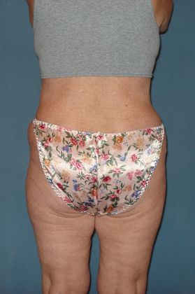 Liposuction: Case 15 - After - back
