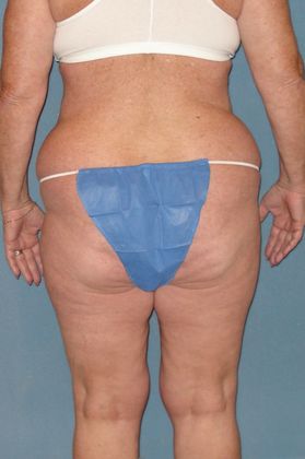 Liposuction: Case 15 - Before - back