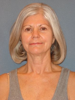 Obagi Skin Care: Case 9 - After