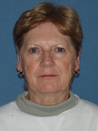 Laser Skin Resurfacing Case 25 - Before