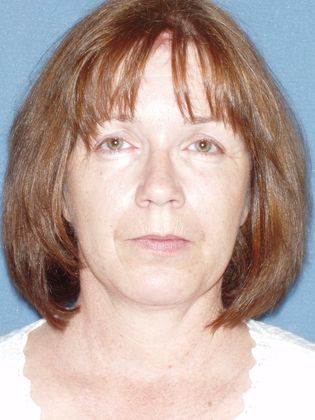 Laser Skin Resurfacing Case 26 - Before