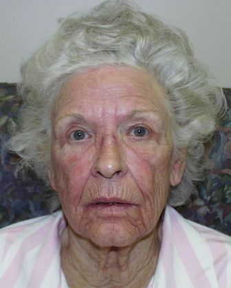 Laser Skin Resurfacing Case 27 - Before