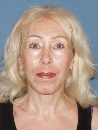 Laser Skin Resurfacing Case 28 - After