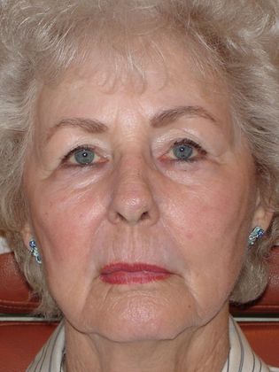 Laser Skin Resurfacing Case 29 - After