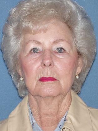 Laser Skin Resurfacing Case 29 - Before