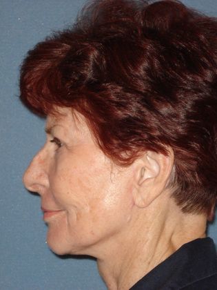 Face & Neck Lifts: Case 18 - After - Side