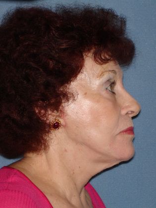 Face & Neck Lifts: Case 19 - After - Side