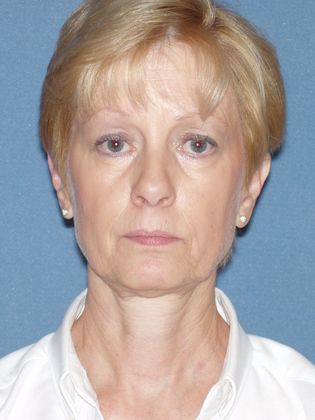 Face & Neck Lifts: Case 20 - Before - Front