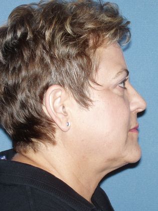 Face & Neck Lifts: Case 21 - After - Side