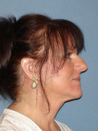 Face & Neck Lifts: Case 22 - After - Side