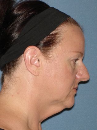 Face & Neck Lifts: Case 22 - Before - Side