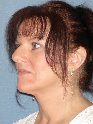 Face & Neck Lifts: Case 22 - After - Side