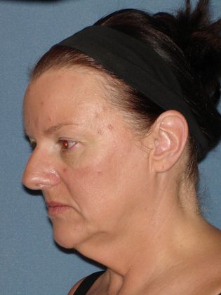 Face & Neck Lifts: Case 22 - Before - Side