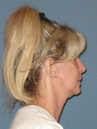 Face & Neck Lifts: Case 24 - After - Side