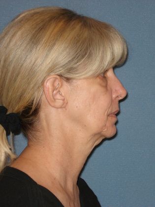 Face & Neck Lifts: Case 24 - Before - Side