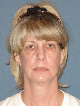 Face & Neck Lifts: Case 24 - After - Front