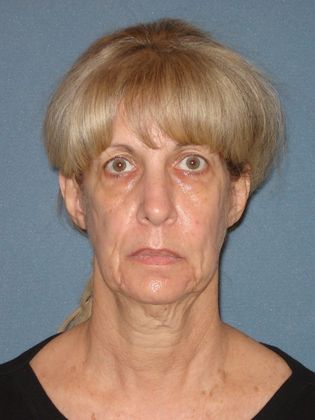 Face & Neck Lifts: Case 24 - Before - Front