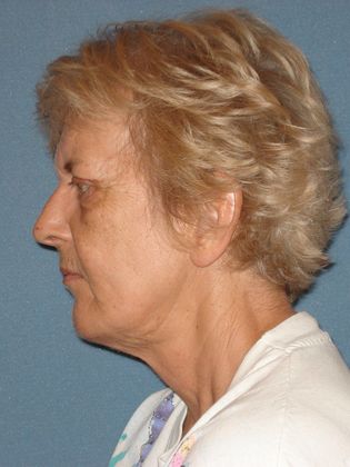 Face & Neck Lifts: Case 26 - After - Side