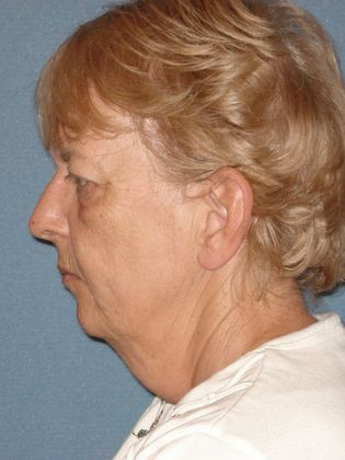 Face & Neck Lifts: Case 26 - Before - Side