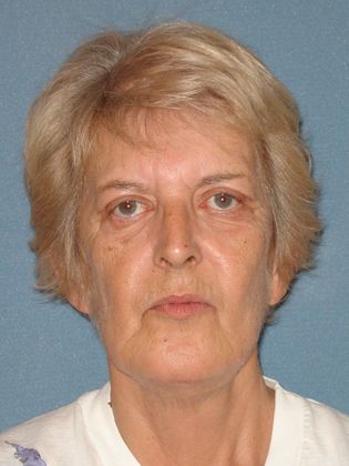 Face & Neck Lifts: Case 26 - After - Front