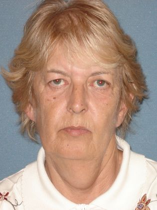 Face & Neck Lifts: Case 26 - Before - Front