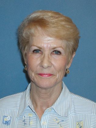 Botox® Cosmetic, Dysport, Xeomin Injectables Case 1 - After