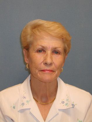 Botox® Cosmetic, Dysport, Xeomin Injectables Case 1 - Before