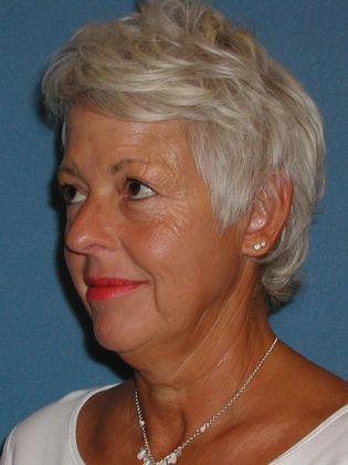 Botox® Cosmetic, Dysport, Xeomin Injectables: Case 3 - After - Side