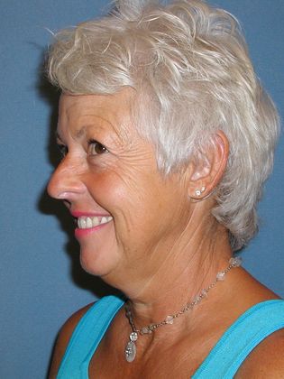 Botox® Cosmetic, Dysport, Xeomin Injectables: Case 3 - Before - Side