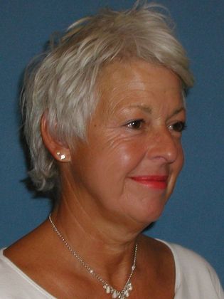 Botox® Cosmetic, Dysport, Xeomin Injectables: Case 3 - After - Side