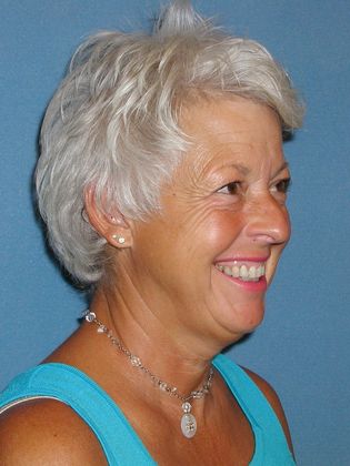 Botox® Cosmetic, Dysport, Xeomin Injectables: Case 3 - Before - Side