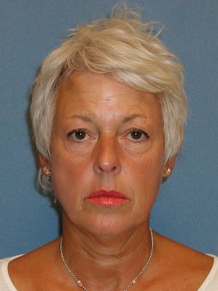 Botox® Cosmetic, Dysport, Xeomin Injectables Case 3 - After