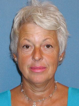 Botox® Cosmetic, Dysport, Xeomin Injectables Case 3 - Before