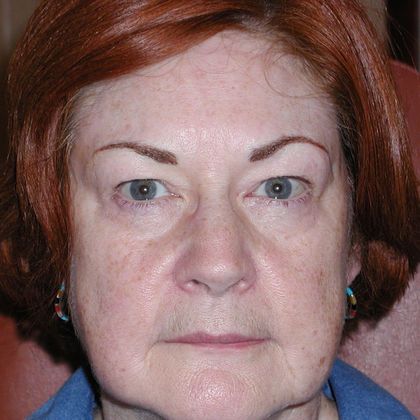 Permanent MakeUp Case 12 - After