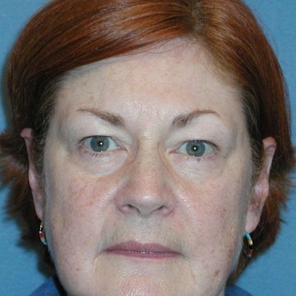 Permanent MakeUp Case 12 - Before