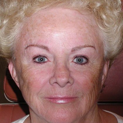 Permanent MakeUp Case 15 - After