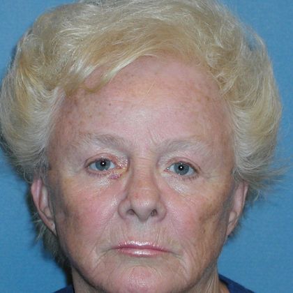 Permanent MakeUp Case 15 - Before