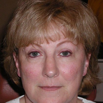 Permanent MakeUp Case 16 - After