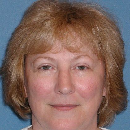 Permanent MakeUp Case 16 - Before