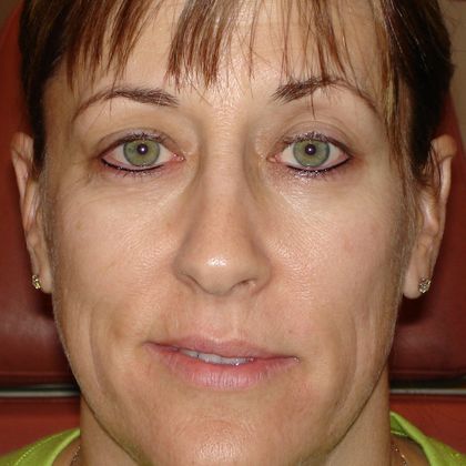 Permanent MakeUp Case 17 - After