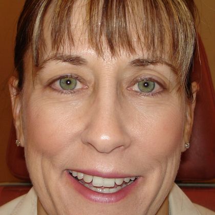 Permanent MakeUp Case 17 - Before